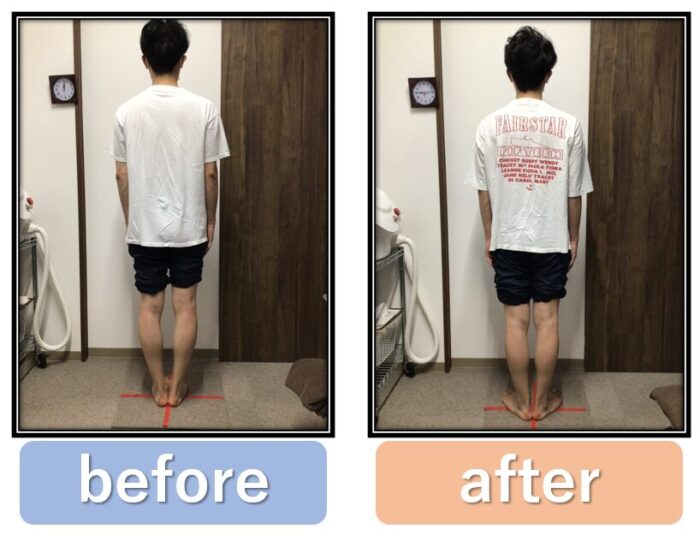 O脚のビフォーアフター