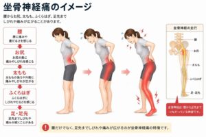 坐骨神経痛で腰からお尻、太もも、ふくらはぎ、足先に痛みやしびれが広がるイメージ