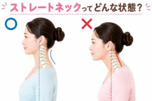 ストレートネックで頭が前に出た姿勢と自然な首の位置を横から比較したイラスト