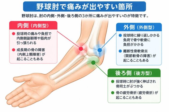 野球肘で痛みが出やすい肘の内側・外側・後ろ側を示した図