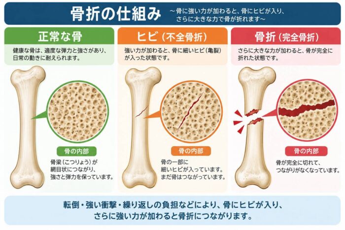 正常な骨とヒビが入った状態、完全に折れた状態を比較した骨折の仕組み