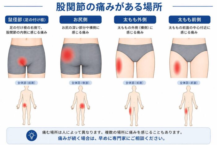 鼠径部やお尻、太ももなど股関節周辺で痛みを感じやすい場所を示したイラスト
