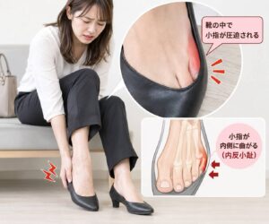 内反小趾で小指が靴の中で圧迫され、痛みを感じている状態のイメージ
