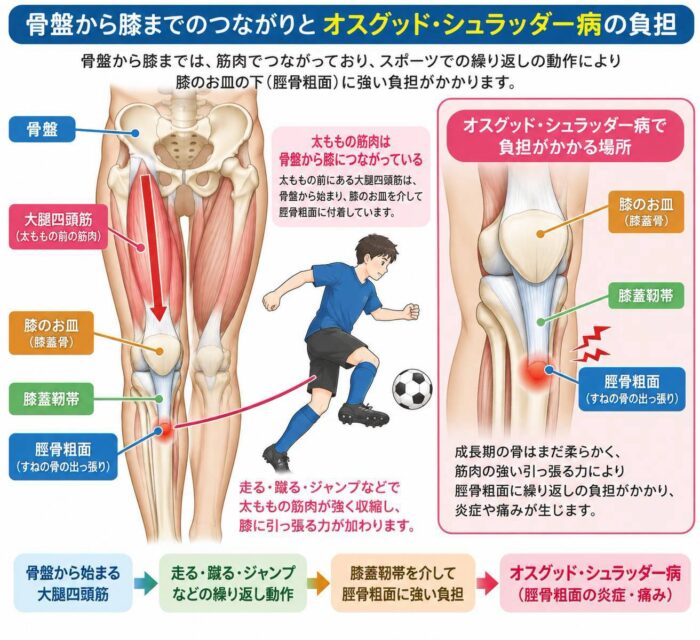 骨盤から大腿四頭筋を通じて膝につながる身体の構造とオスグッド・シュラッター病への負担を示した図