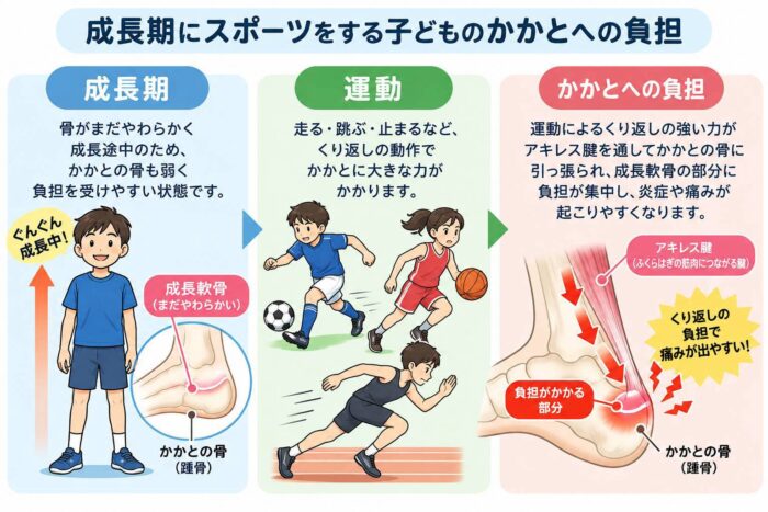 成長期の子どものかかとにスポーツによる負担がかかる仕組みを示したイラスト