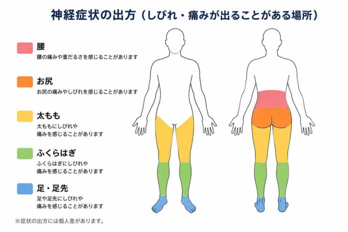 脊柱管狭窄症で痛みやしびれが出ることがある腰、お尻、太もも、ふくらはぎ、足の場所を示した図