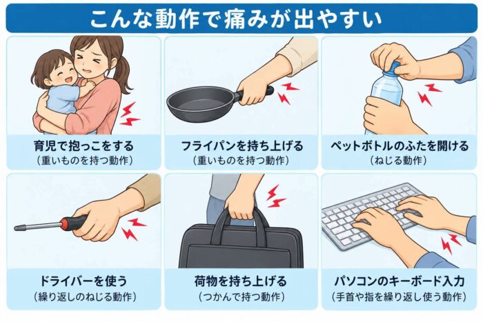育児や料理、荷物を持つ動作、パソコン操作などでテニス肘の痛みが出やすい場面